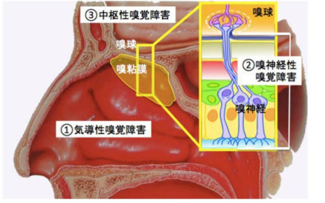 嗅覚障害の種類