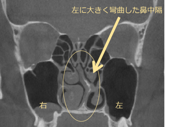 CT検査