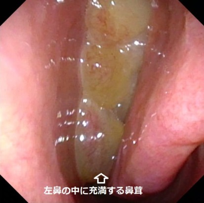 好酸球性副鼻腔炎とは?